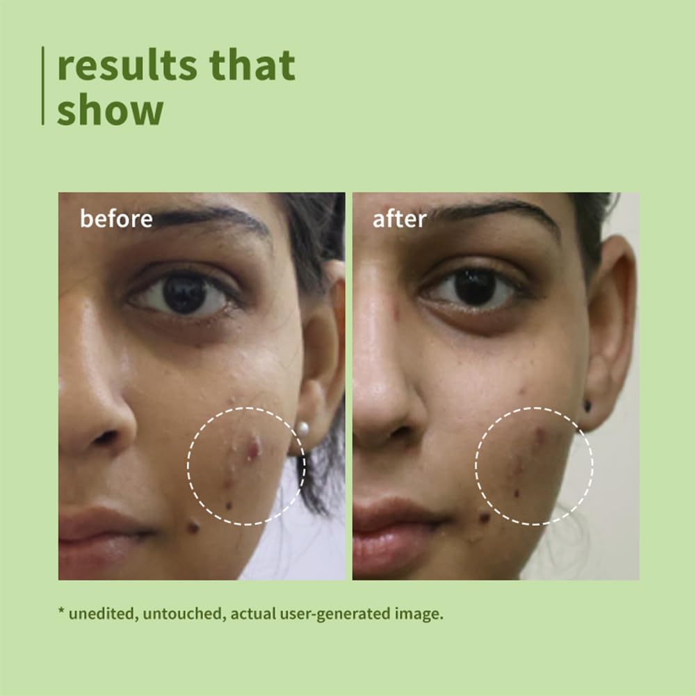 Green Tea Face Wash for Acne & Oily Skin | 1% Salicylic Acid | Deep Cleansing Face Cleanser | Oil Control | 100ml