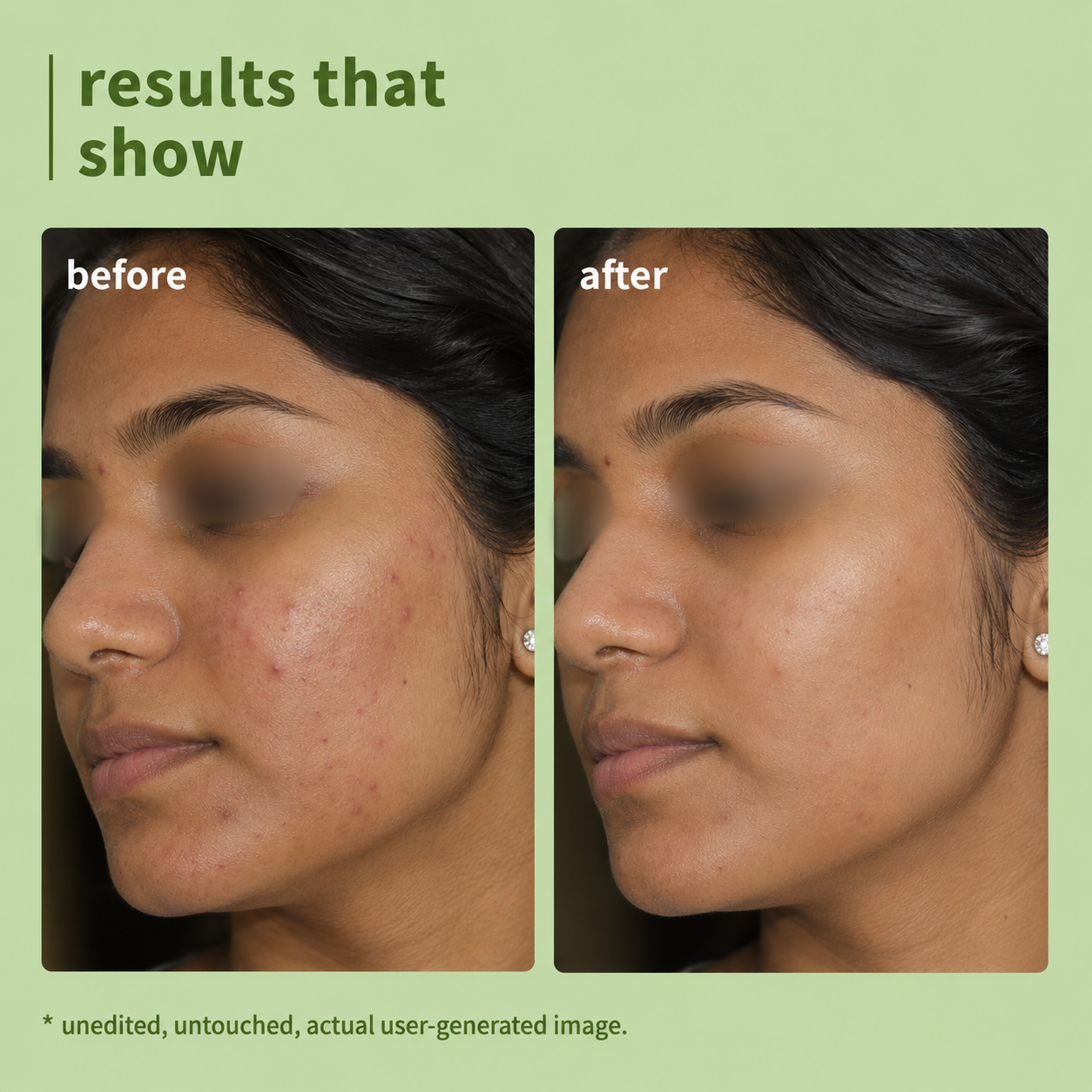 Green Tea Face Wash for Acne & Oily Skin | 1% Salicylic Acid | Deep Cleansing Face Cleanser | Oil Control | 100ml